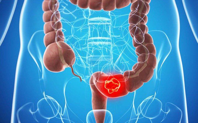 Các dấu hiệu sớm của ung thư trực tràng | Vinmec