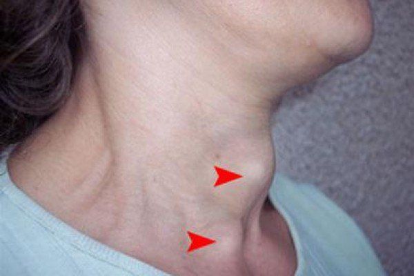 Có thể điều trị bệnh basedow được không? | Vinmec
