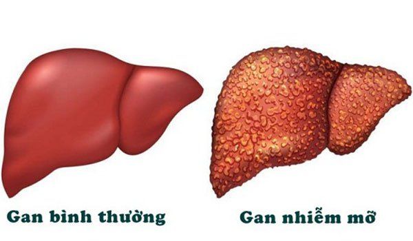Foods that help maintain balance for fatty liver disease - Vinmec