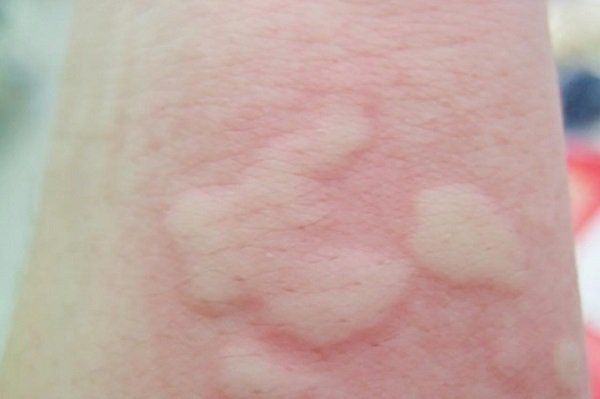 Ngứa toàn thân kèm nổi cục trên da là bệnh gì? | Vinmec