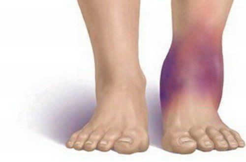 Gãy xương sên khiến cổ chân người bệnh bầm bím và sưng phù.