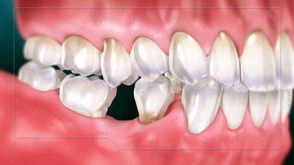 Mất 1 răng hàm có sao không? | Vinmec