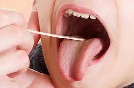 Cuống lưỡi mọc những nốt mụn đỏ u nhú lên là bị làm sao?