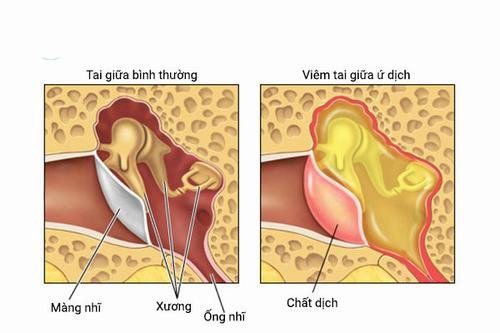 Điều trị viêm tai giữa ứ dịch như thế nào?