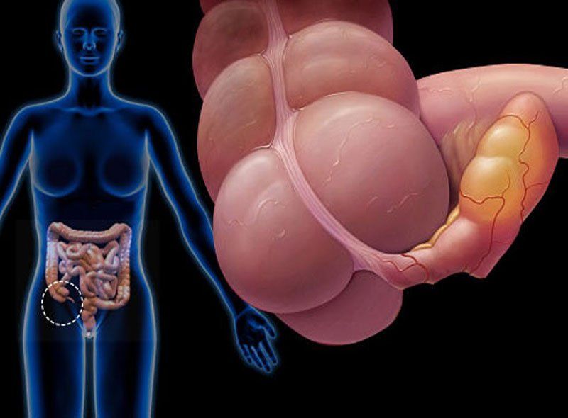 Viêm ruột thừa: Nguyên nhân và các phương pháp điều trị | Vinmec