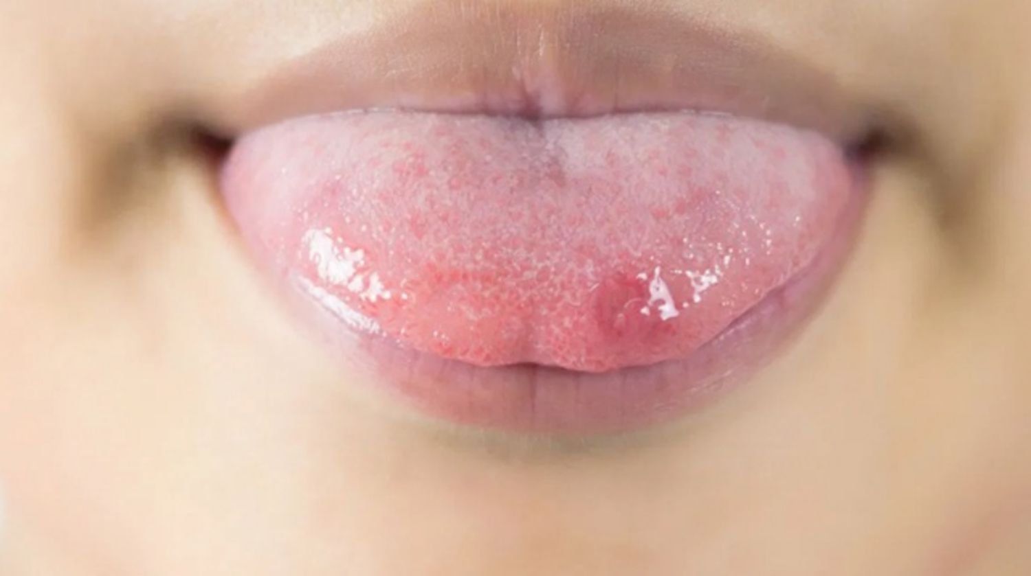 C&aacute;c vấn đề về lưỡi: Lo&eacute;t, đổi m&agrave;u | Vinmec