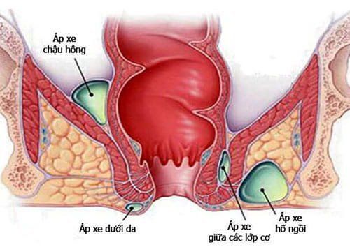 Sau khi mổ apxe hậu môn 1 năm có mủ kèm dịch nhầy nên đi khám không?