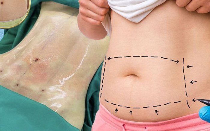 CÓ NÊN HÚT MỠ BỤNG KHÔNG CẦN TƯ VẤN KỸ TRƯỚC KHI THỰC HIỆN