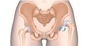 Thoái hóa khớp háng chiếm khoảng 50% trong các trường hợp thoái hóa khớp hiện nay.