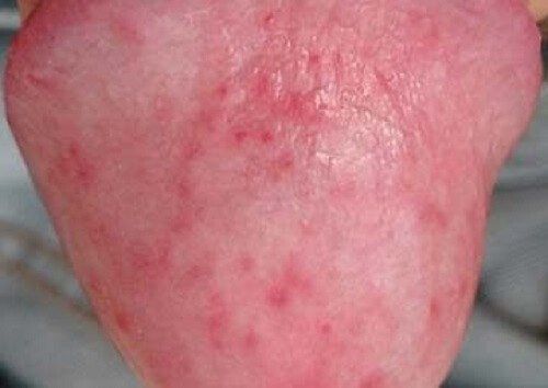 Understanding Types Of Genital Pimples In Men And Women Vinmec