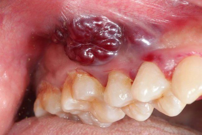 HÌNH ẢNH UNG THƯ RĂNG GIAI ĐOẠN CUỐI VỚI TỔN THƯƠNG LAN RỘNG
