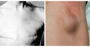 Patients with metastatic breast cancer often have swollen lymph nodes in the armpit