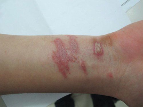 Patients affected by dermatitis due to rove beetles need treatment according to medical guidance.