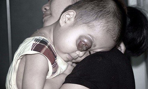 Eye Cancer in Children Is Commonly Seen in Those Under 2 Years Old
