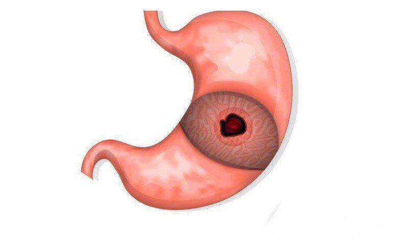Dấu hiệu thủng ổ loét dạ dày | Vinmec