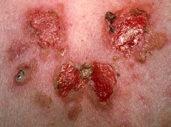 Thuốc Hydrocolacyl được sử dụng điều trị bệnh Pemphigus