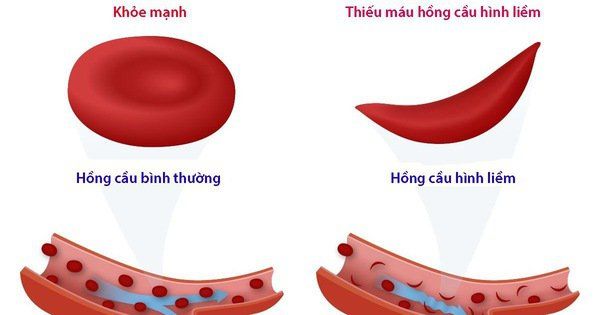 Sự khác biệt về hình thái giữa hồng cầu bình thường và hồng cầu hình liềm dưới kính hiển vi