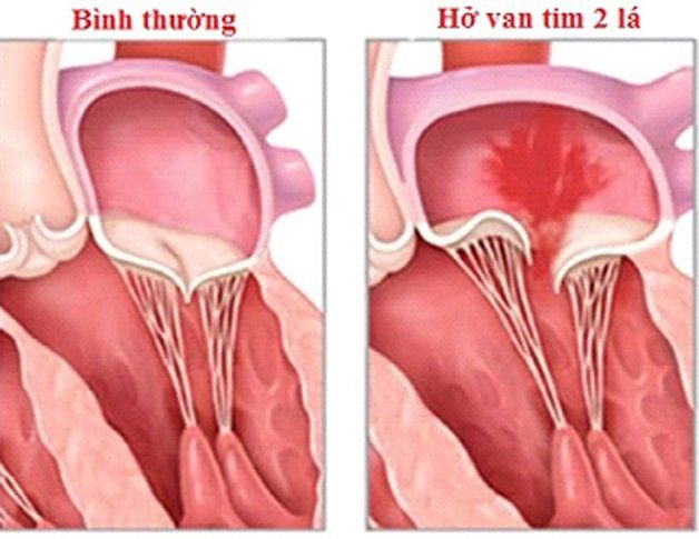 hở van tim 3 lá 1.5 4 là gì