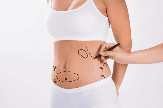 đo vẽ trước khi hút mỡ