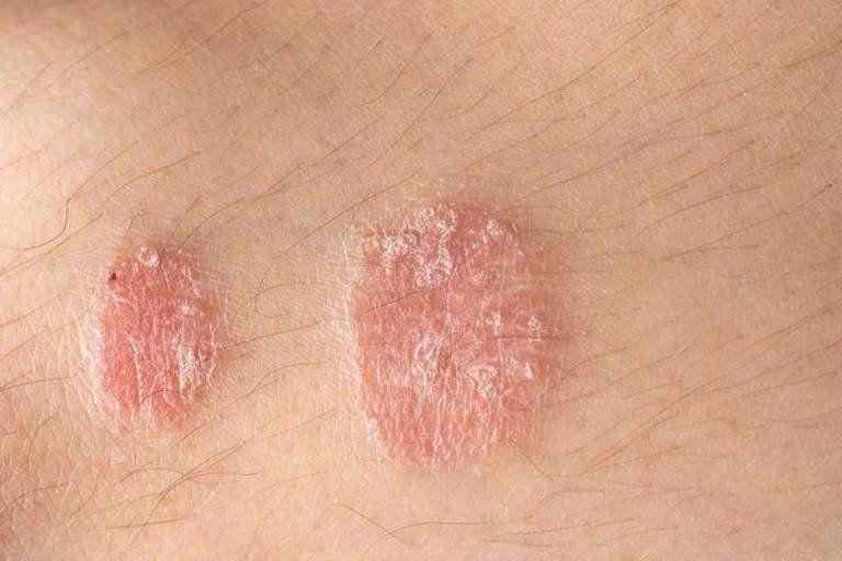 Điều trị dứt điểm vảy nến k&eacute;o d&agrave;i như thế n&agrave;o? | Vinmec