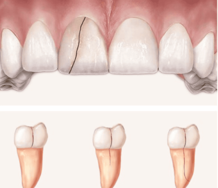 Tác Hại Khi Không Điều Trị Răng Trám Bị Nứt