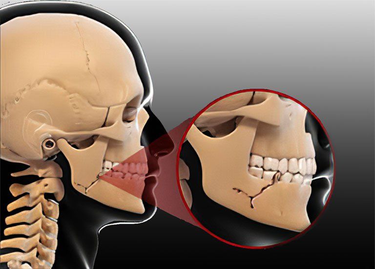Bài tập phục hồi sau gãy xương hàm | Vinmec