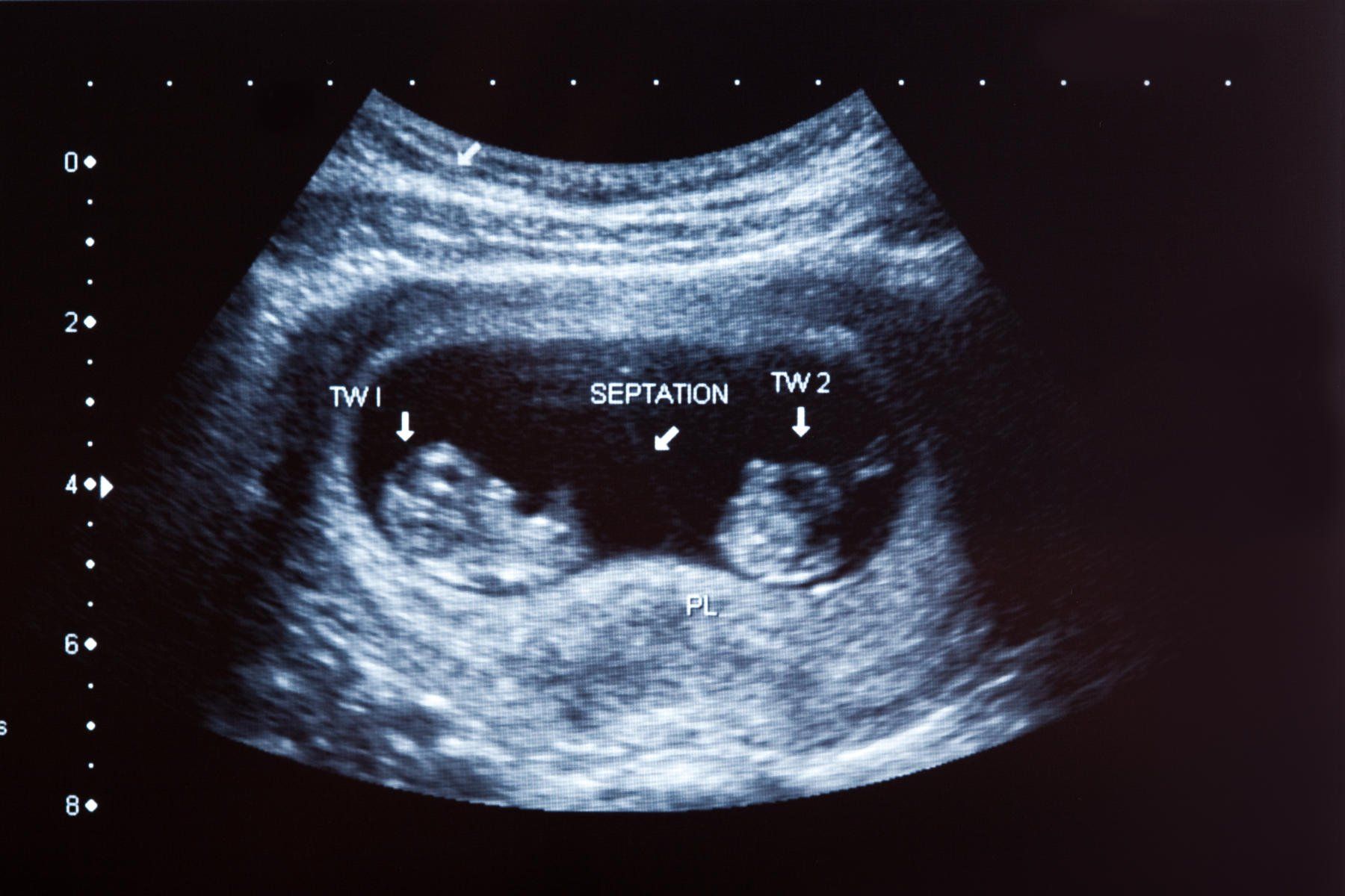 Grayscale ultrasound showing two gestational sacs labeled TW1 and TW2, with septation indicating possible dichorionic twins