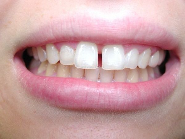 Làm gì khi bị hở kẽ răng cửa? | Vinmec