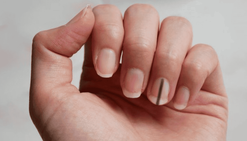 Móng tay có đường sọc màu tối là dấu hiệu bệnh gì? | Vinmec