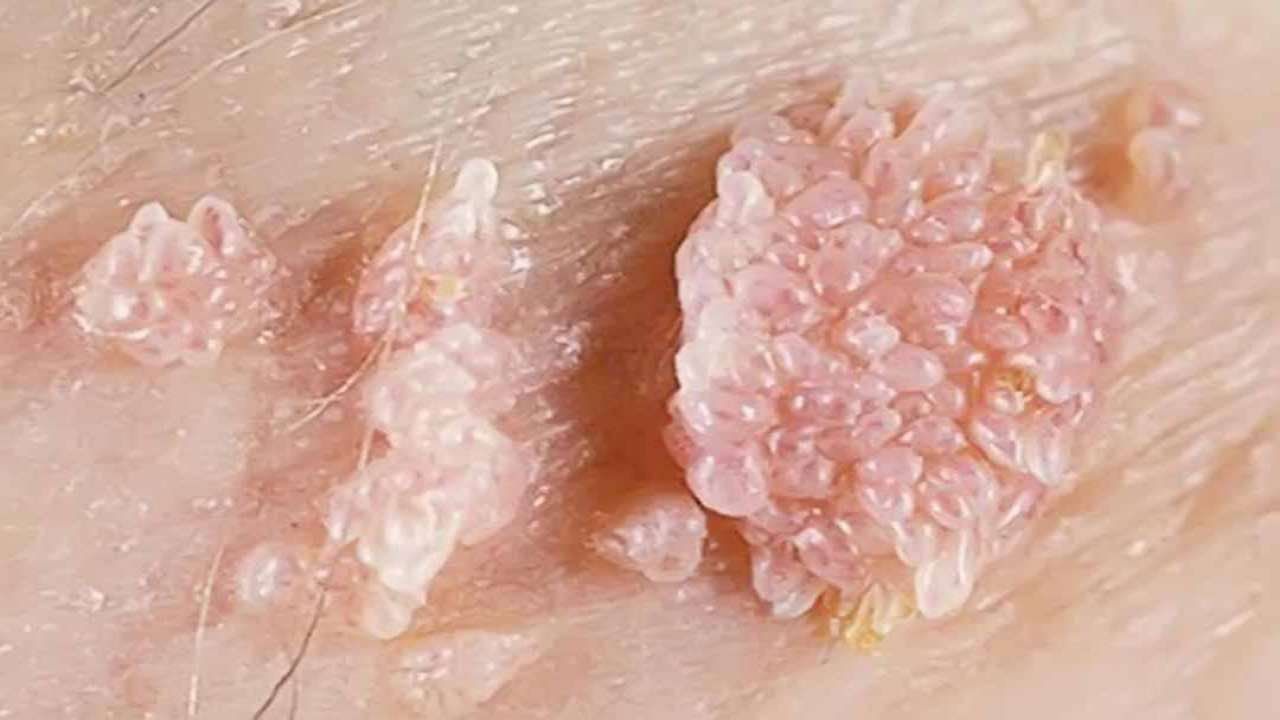 Condyloma l&agrave; bệnh g&igrave;? | Vinmec