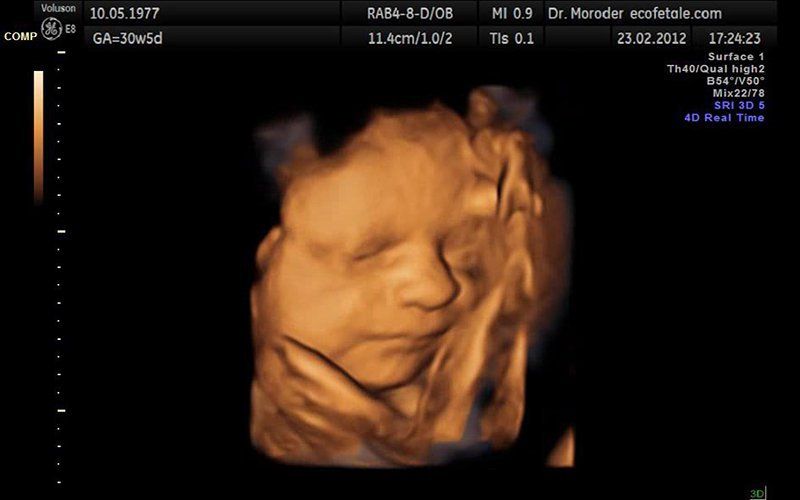 Siêu Âm 4D Thai Nhi 18 Tuần Tuổi: Khám Phá Hình Dáng Và Sự Phát Triển Tuyệt Vời Của Bé