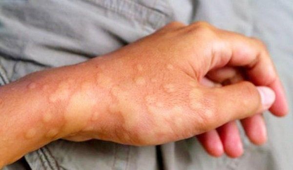 Mẩn Ngứa Nổi Cục - TRISO