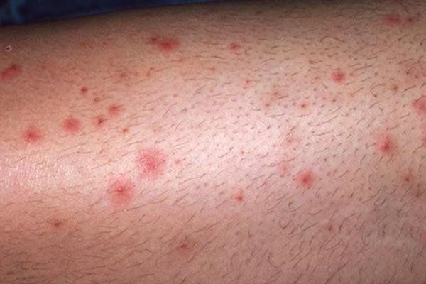 Mẩn đỏ trên da có thể xuất hiện ở chân hoặc tay với nhiều hình dạng khác nhau