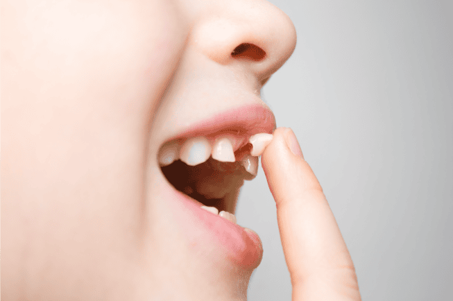 Nhổ răng sữa sớm có ảnh hưởng gì không? | Vinmec