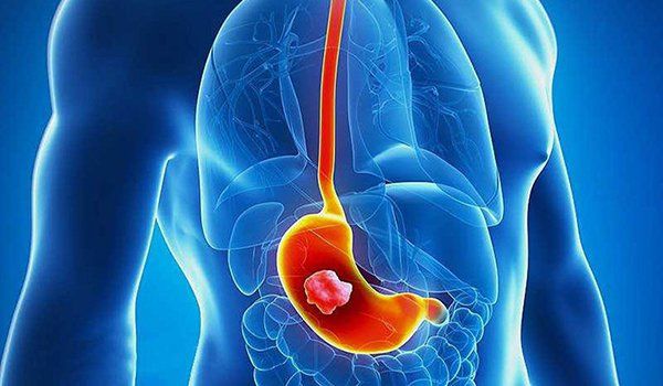 Bệnh ung thư dạ dày thường di căn đến đâu? | Vinmec