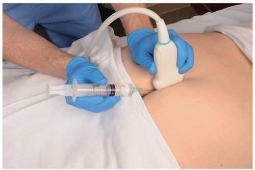 A nerve block uses local anesthetics and corticosteroids injected directly into the coccygeal nerve.