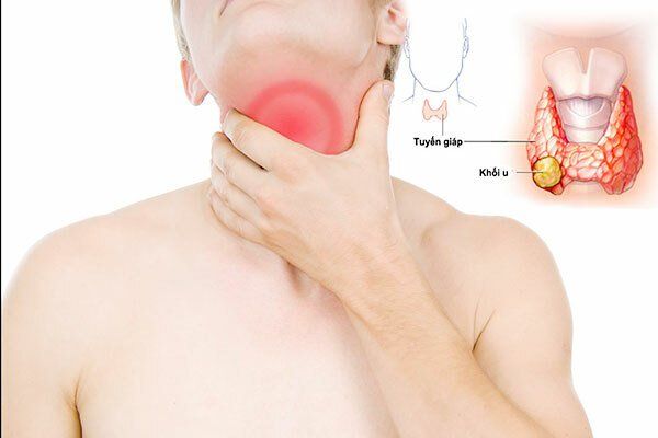 GIAI ĐOẠN UNG THƯ TUYẾN GIÁP DI CĂN HẠCH QUYẾT ĐỊNH PHÁC ĐỒ ĐIỀU TRỊ PHÙ HỢP