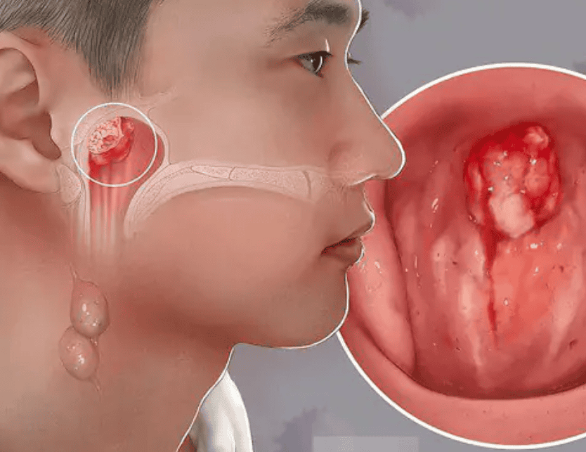 Chẩn đoán hình ảnh ung thư mũi | Vinmec