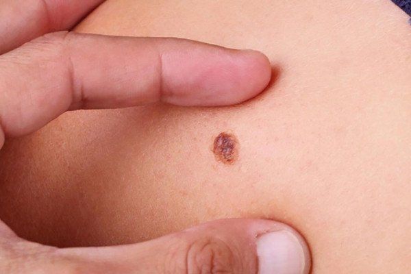 U hắc tố l&agrave;nh t&iacute;nh của da | Vinmec