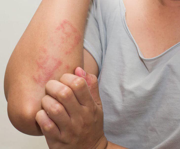 C&aacute;ch chữa nổi mề đay người bệnh cần nắm để điều trị hiệu quả | Vinmec