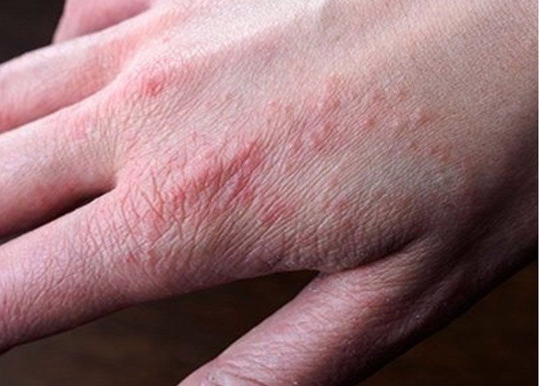 Nổi mẩn đỏ ở tay chân sau khi ăn xong và khi đi ngủ có sao không? | Vinmec