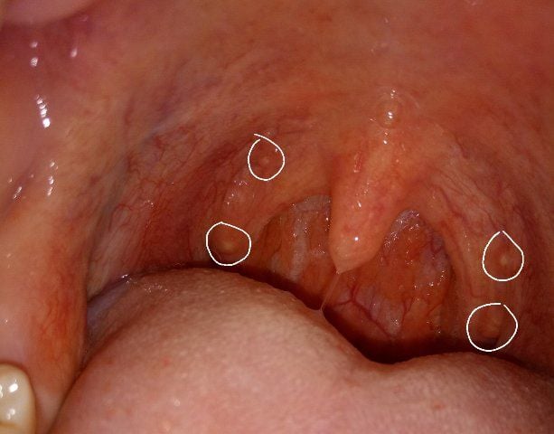 &Ecirc; cổ họng, nổi hạt nhỏ m&agrave;u trắng l&agrave; bệnh g&igrave;? | Vinmec