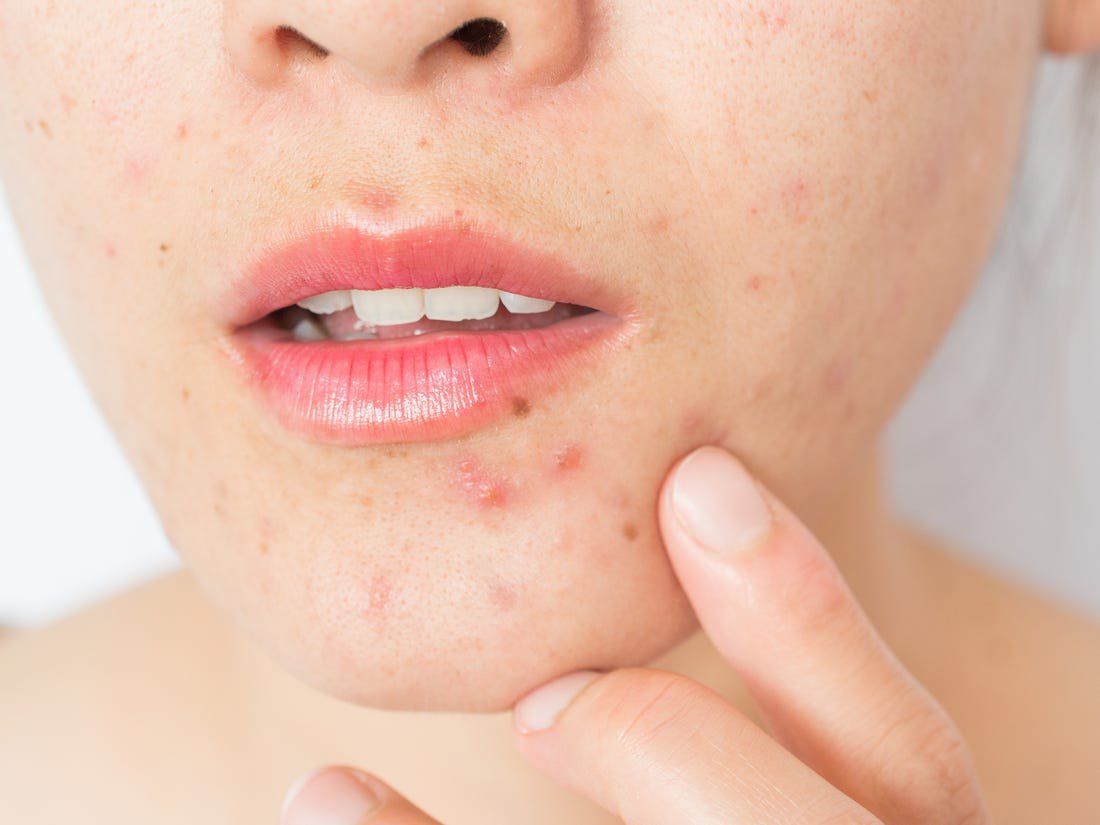 VỊ TRÍ THƯỜNG GẶP CỦA MỤN NỘI TIẾT TRÊN KHUÔN MẶT NGƯỜI BỆNH