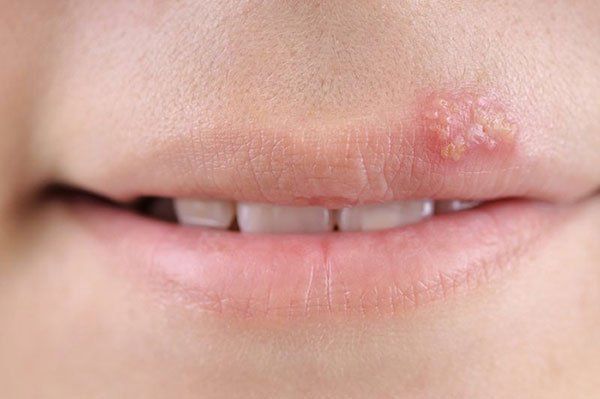 MỤN Ở MÉP MIỆNG KÈM THEO SƯNG VÀ ĐAU RÁT NHẸ
