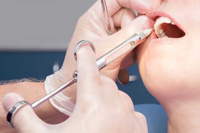 TIÊM THUỐC TÊ NHỔ RĂNG CÓ ĐAU KHÔNG PHỤ THUỘC VÀO ĐÚNG QUY TRÌNH VÀ LIỀU LƯỢNG