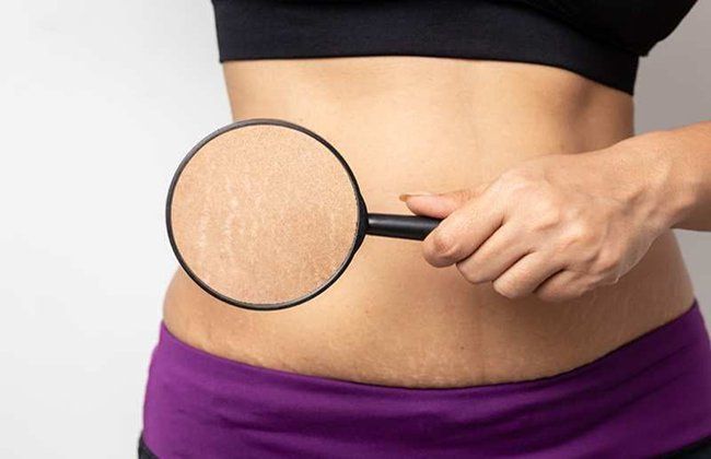 5 cách trị rạn da do tăng cân mà không phải ai cũng biết 5 cách trị rạn da do tăng cân mà không phải ai cũng biết