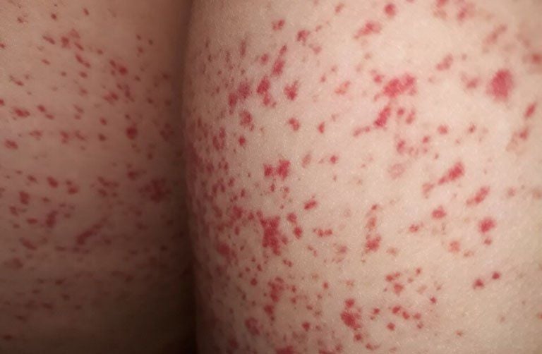 10 nguyên nhân khiến da nổi đốm đỏ | Vinmec