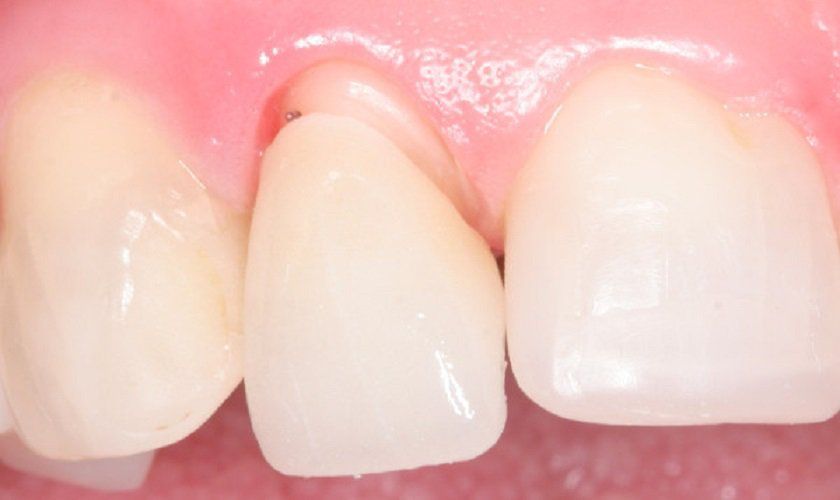Các dấu hiệu răng sứ bị hở | Vinmec