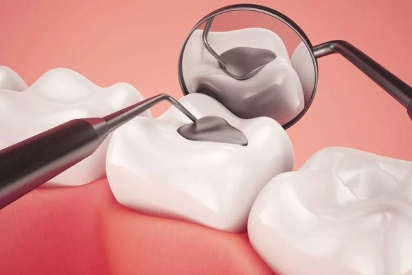 Các bước trám răng | Vinmec