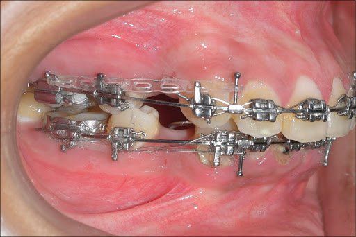 Đóng khoảng răng khi niềng mất bao lâu? | Vinmec